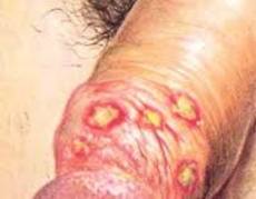 Симптом заражения половым сифилисом у мужчин: твердый шанкр и сыпь