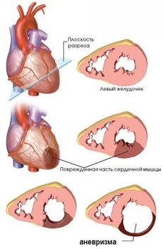 Аневризма сердца: описание болезни, симптомы, рекомендации по лечению